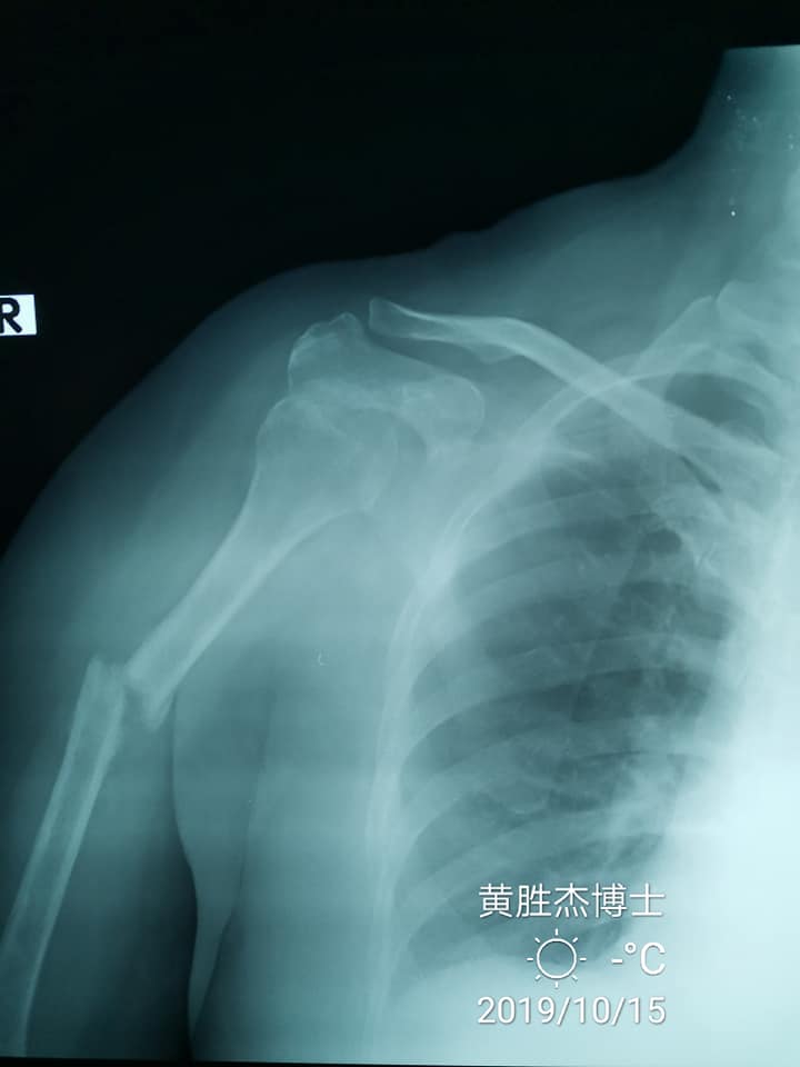 病人在某著名跌打师治疗骨折 9个月了从来没有拍xray 导致悲剧发生 国医堂